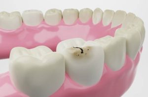 拔智齒的洞黑黑的