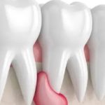 智慧齒牙肉包住