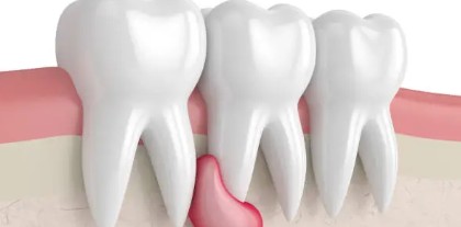 智慧齒牙肉包住正常嗎？智慧齒咬到牙肉原因、症狀＆改善方法