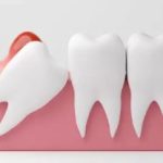 智齒長出一小角