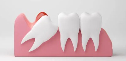 智齒長出一小角可以拔嗎？了解智齒長出一小角原因＆處理方式