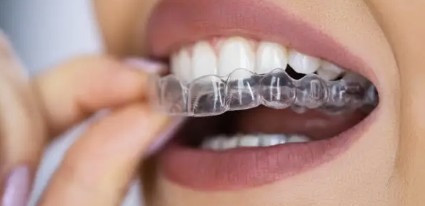 隱適美Invisalign好唔好？隱適美優缺點、價錢及常見問題