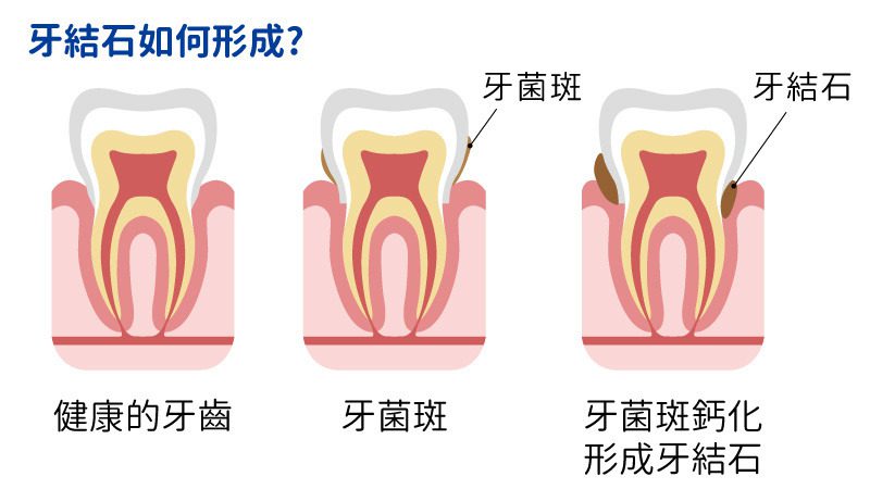牙石脫落方法 牙結石形成過程