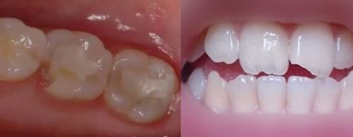 牙齒掉一小塊可以補嗎