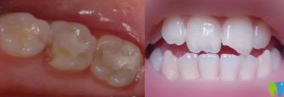 牙齒掉一小塊可以補嗎