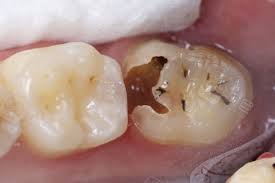 牙齒掉一小塊怎麼辦