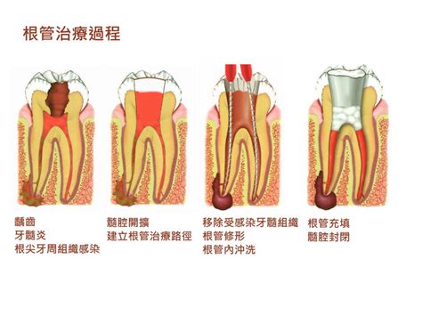 牙神經痛怎麼辦：根管治療牙醫操作過程示意