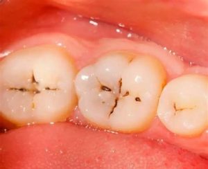 牙齒黑黑的刷不掉 牙齒裂溝與黑色點可能原因示意