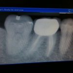 小朋友杜牙根 牙片