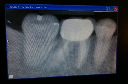 小朋友杜牙根 牙片