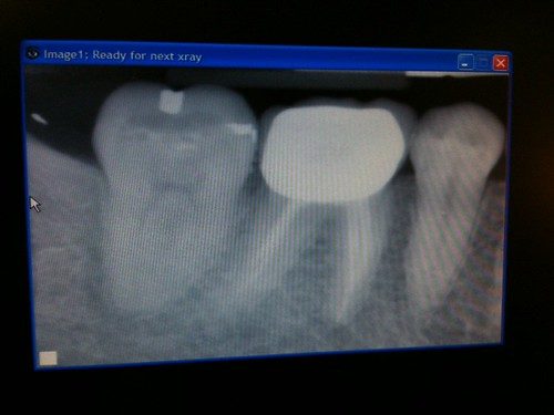 小朋友杜牙根 牙片