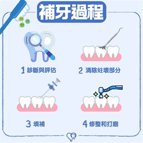 旺角牙醫補牙治療示意圖片