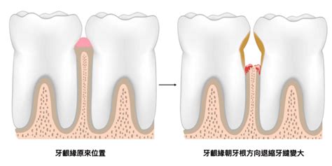 牙周病牙齦萎縮牙縫變大口腔結構示意圖