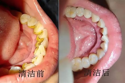 牙縫卡東西牙線弄不出來